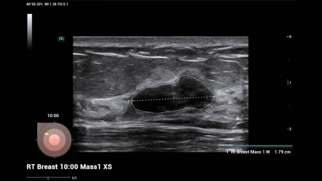 Mindray Consona N8 с Smart Breast — точная диагностика, уверенность в результатах